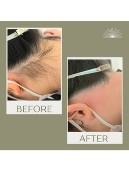 ムー 表参道店(mou)/うなじダブル脱毛before&after 