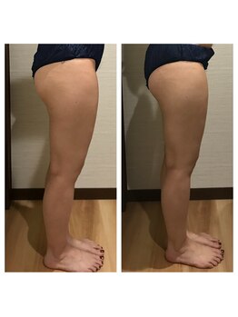 かたぎり接骨院/リリースカッターbefore after