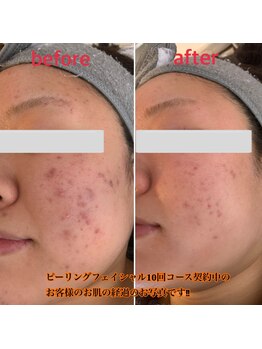 シャルム(Charme)/ピーリングフェイシャル