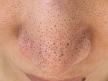 ウミ(Ummi)/元のお鼻