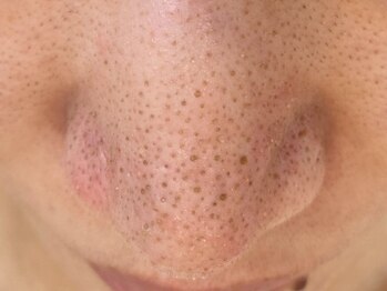 ウミ(Ummi)/元のお鼻