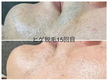 CDF 赤坂/メンズヒゲ脱毛15回目初回￥1000