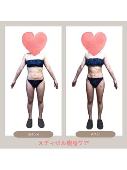 トレゾアスィス(Tresor sis)/痩身/ダイエット/筋膜リリース