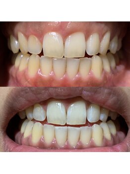 ティースクリーン(Teeth Clean)/セルフホワイトニング1回