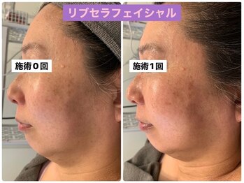 プリュネル(Prunelle)/プラズマシャワー