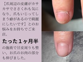 パラジェル深爪緩和クリアコース