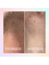 フレイヤビューティー スハダラボ 恵比寿(Freyia Beauty Suhada LABO)/-メンズ髭脱毛-恵比寿