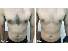 メン脱(Men脱)の雰囲気（全身脱毛が一番人気◎お客様に合わせた脱毛menuをご提案します）
