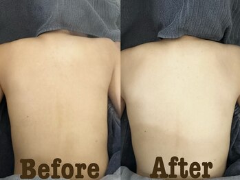 シード(SHE°)/ハーブピーリング