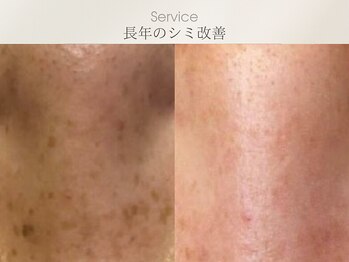 フェイシャルサロン ベルダ(BELDA)/【長年のシミを改善】