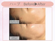 クイーンズチャーム(Queen's Charm)/ハーブピーリング★