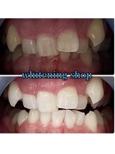 ホワイトニングショップ 加古川店/当店独自の高品質なジェルで美白