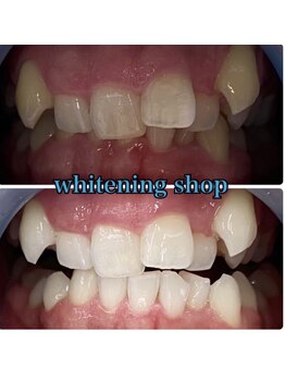 ホワイトニングショップ 加古川店/当店独自の高品質なジェルで美白