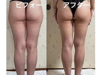 ラレコルト/ビフォーアフター