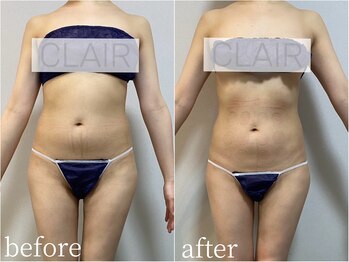 クレール(CLAIR)/痩身マシンTAMURA3