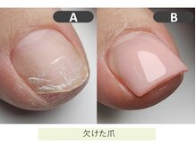 アウラ ネイル ファクトリー(aura nail factory)/フット深爪矯正(長さだし)赤羽駅
