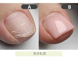 フット深爪矯正(長さだし)赤羽