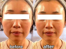 ジジベレッザ 芦屋店(jiji belleza)/【脂肪撃退×幹細胞】美肌更新★