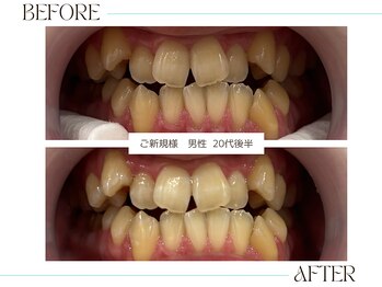 ホワイトニングサロンブライト 尼崎店(Whitening salon bright)/ご新規様のbefore/after