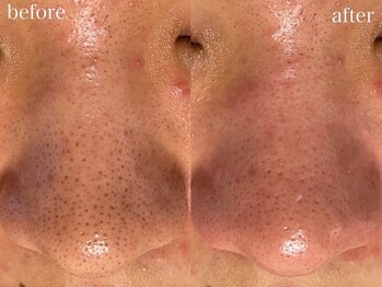 ホワイトアクア 池袋店(WHITE AQUA)/ハーブピーリング/毛穴洗浄/池袋