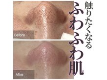 癒える(ielu)/毛穴B/A★2回目