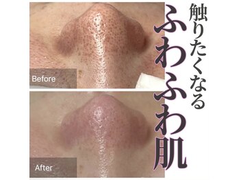 癒える(ielu)/毛穴B/A★2回目