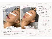 ミュラ(myura)の雰囲気（韓国最先端技術の溶ける糸リフト）