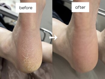 ペネイル 神戸(Penails)の写真/【神戸駅徒歩3分】冬の乾燥を撃退!1回で赤ちゃんかかとが叶う★感動フット角質ケア♪