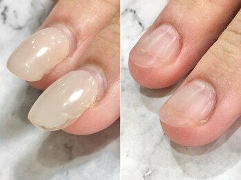 リファーレ(RIFARE)の写真/【他店修正】もっと自然な見た目にしたい…他店で深爪矯正中でもRIFAREへの乗り換えが可能です◎