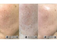 オリーブ ミィ(Olive 美)/ハーブピーリング