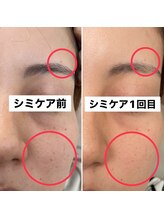 モイラ(MOIRA)/シミケア１回目！