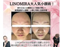 リノミラ(LINOMIRA)/小顔リフトアップ