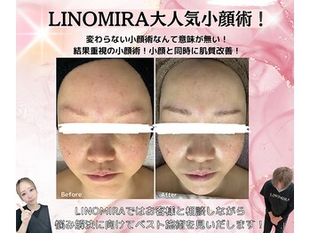 リノミラ(LINOMIRA)/小顔リフトアップ
