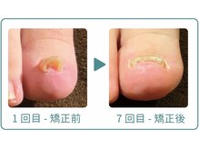 巻き爪研究所 表参道院/丸まった巻き爪も正常な形へ