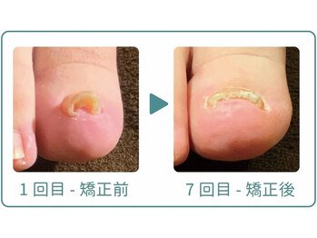 巻き爪研究所 表参道院/丸まった巻き爪も正常な形へ