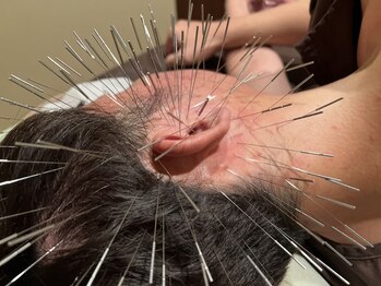 オリエントセラピー(ORIENT THERAPY)/難聴特化型ルート鍼