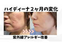 ヨサパーク ハナ(YOSA PARK hana)/水素酸素吸入での肌改善