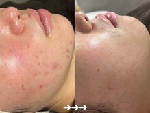 フロラスキン 銀座Miel店(florasKIN)/肌質改善プログラム