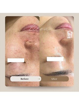 ヒュウ(hue.)/韓国発最新肌管理[セルマン]