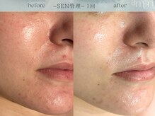 SEN管理/赤ら顔くり返すニキビケア