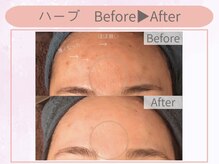 クイーンズチャーム(Queen's Charm)/輝く美肌★ハーブピーリング