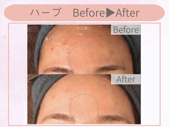 クイーンズチャーム(Queen's Charm)/輝く美肌★ハーブピーリング