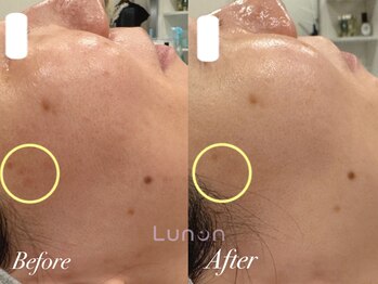 ルノン(Lunon)/毛穴洗浄ハイドロ×ララピール