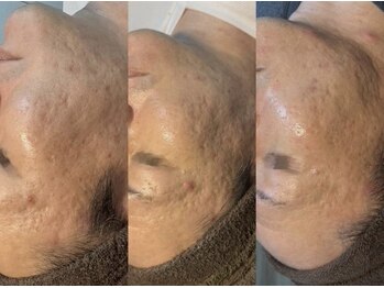 セルヴィノバ(CELL VI NOVA)/＊ビフォーアフター