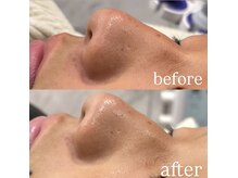 リミー(Reme)/お肌に潤いを与えながらのケア！