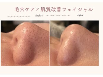 エステティックサロン シーズ/黒ずみ毛穴を改善