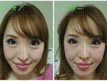 泉町鍼灸整骨院/美容鍼ビフォー→アフター　