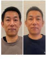 長寿鍼灸院 長寿整骨院/men's美容鍼50本効果★