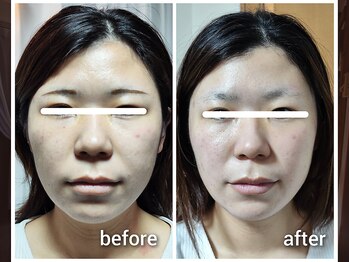 セレナ 川越/フェイシャルエステで変わる!