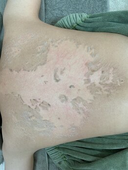 スリジエ ボーテ(cerisierBEAUTE)/お薬によるお腹の黒ずみにも◎